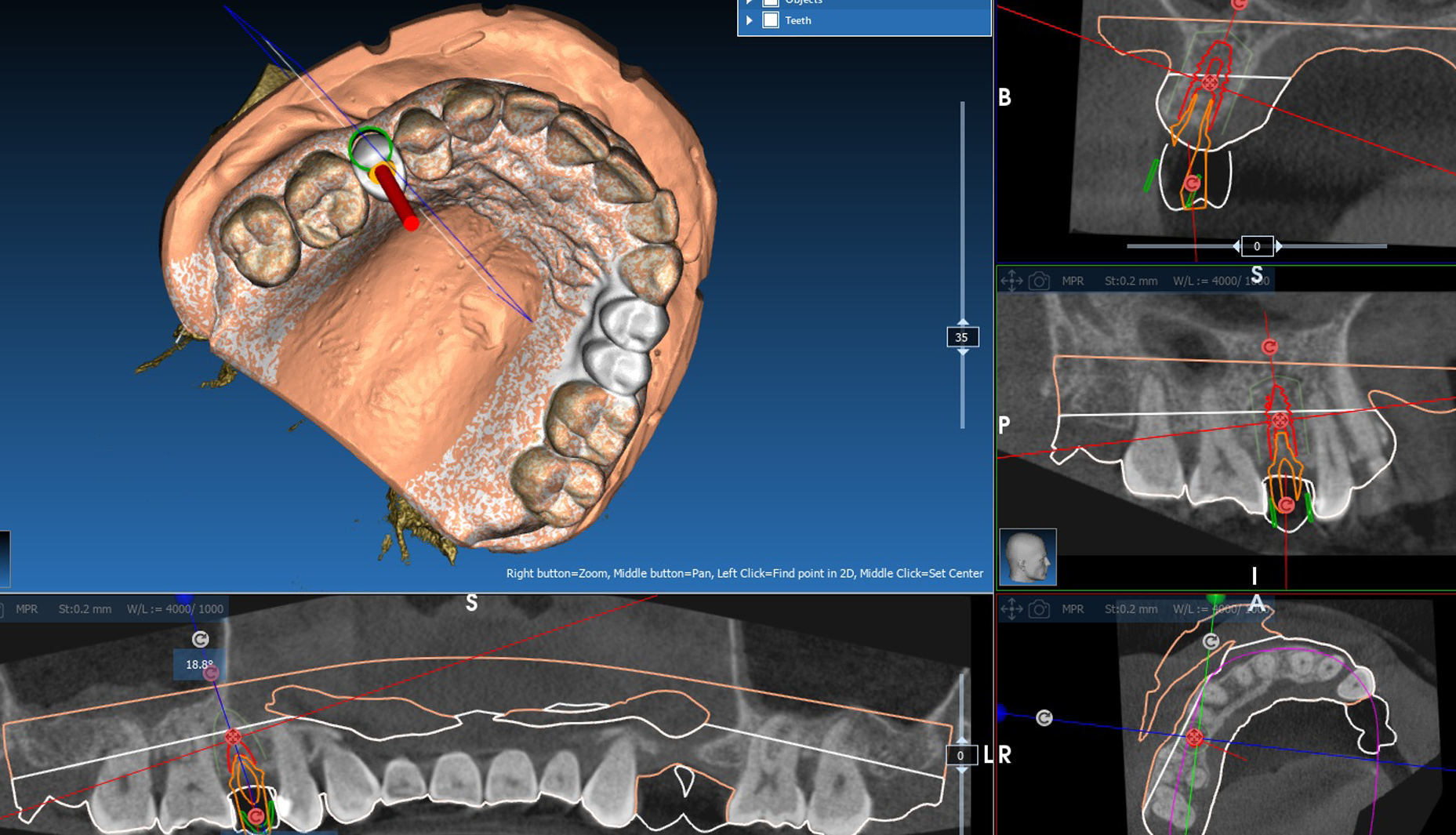ICX-P5 Intraoral Scanner